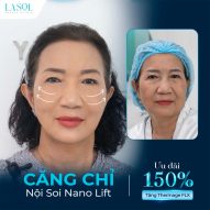 CĂNG CHỈ NỘI SOI NANO LIFT – TRẺ HOÁ TOÀN DIỆN