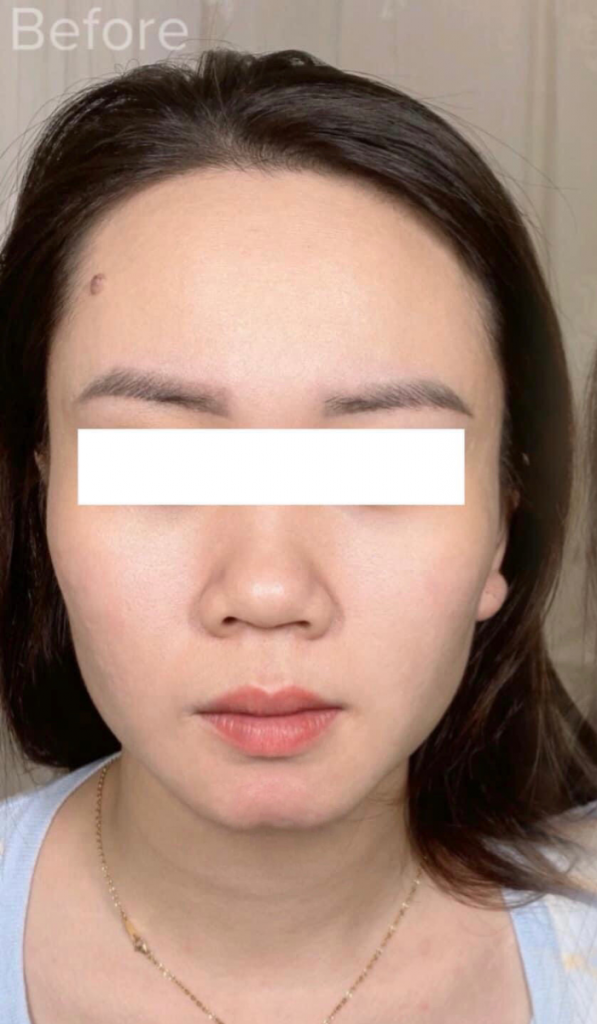 Căng Sợi Tơ Vàng 24K – Giải Pháp Trẻ Hóa Chuẩn Y Khoa Tại Doctor Minh Tú (Lasol Beauty)