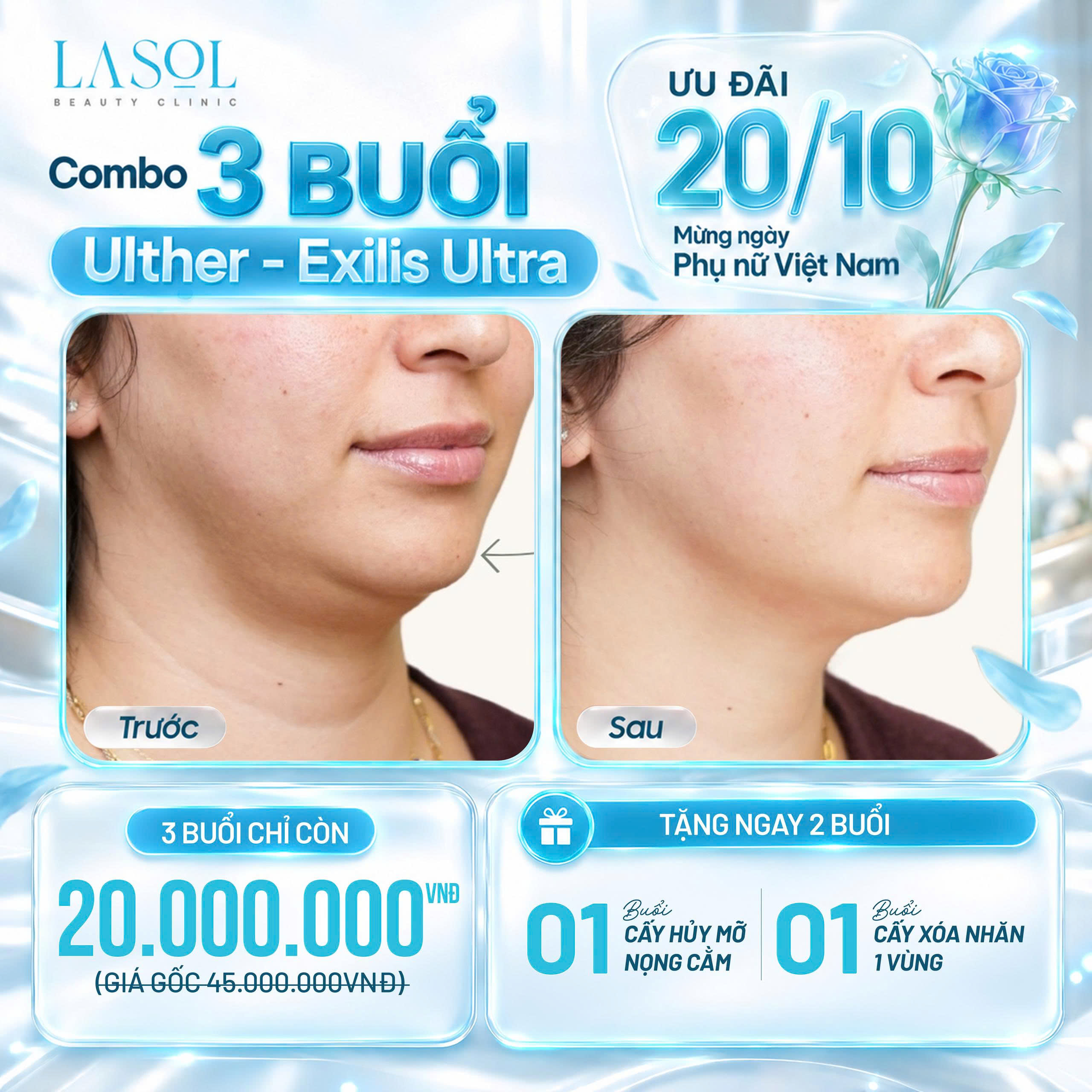 ĐỊNH HÌNH ĐƯỜNG NÉT V-LINE CHỈ VỚI 20 TRIỆU ĐỒNG